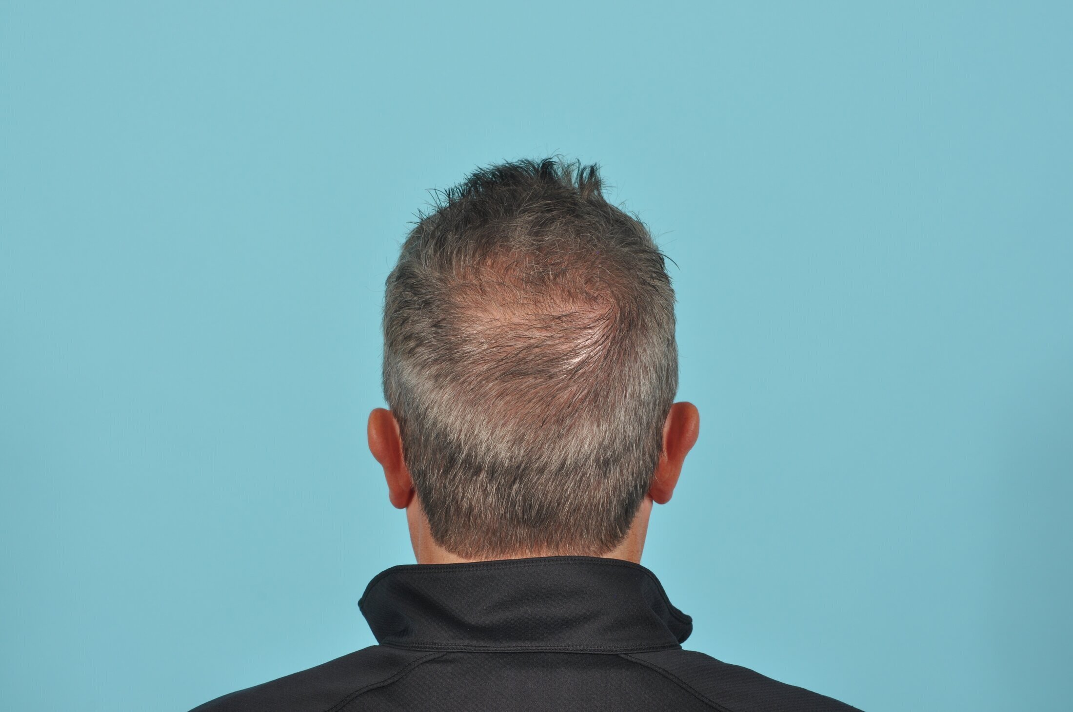 Hair Transplant Candidate Grand Rapids 