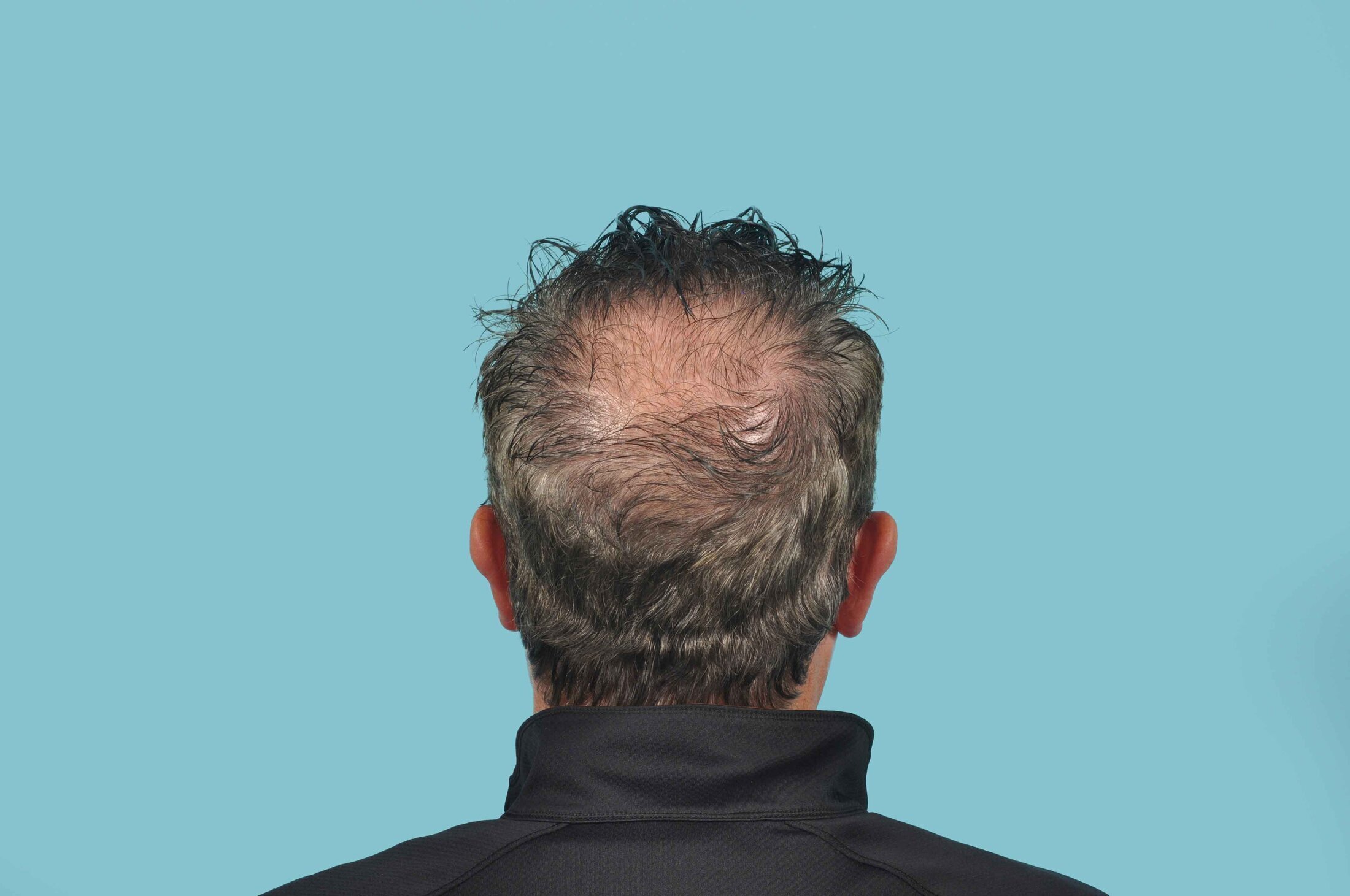 Hair Transplant Candidate Grand Rapids 