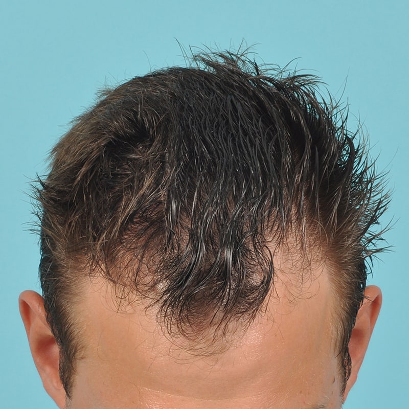 NeoGraft - Hair Restoration Before & After Image