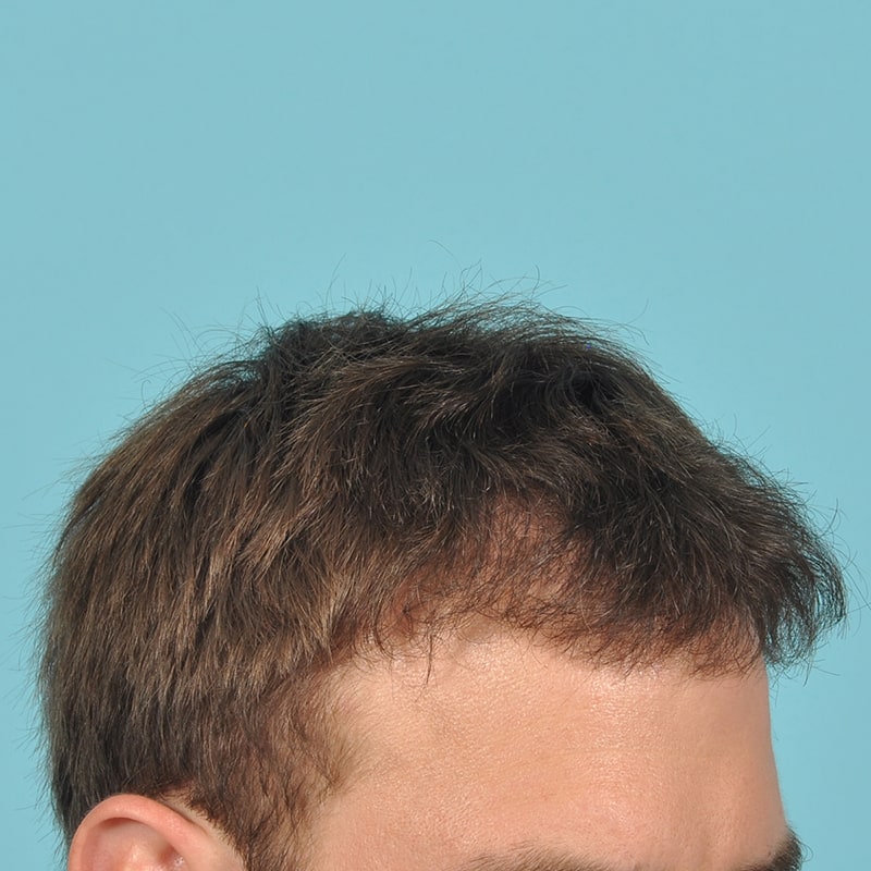 NeoGraft - Hair Restoration Before & After Image