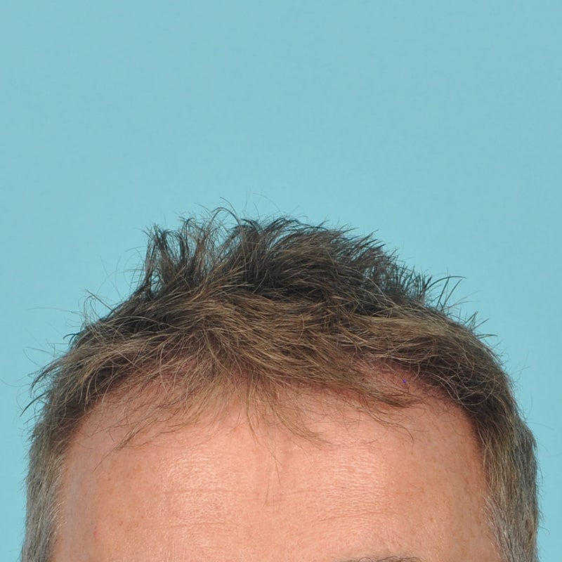 NeoGraft - Hair Restoration Before & After Image