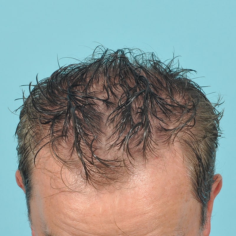 NeoGraft - Hair Restoration Before & After Image