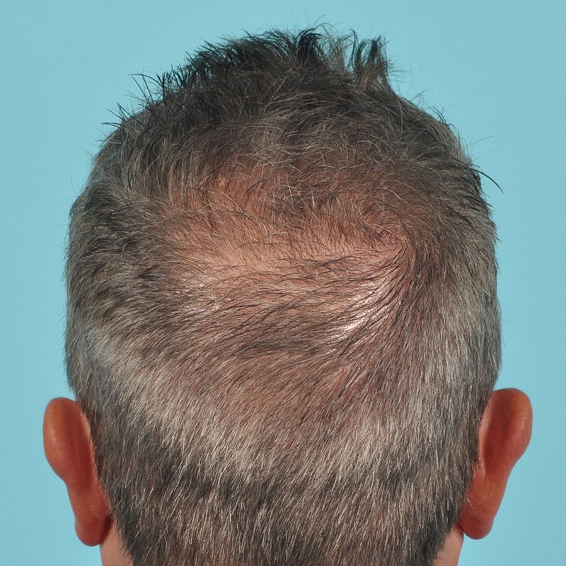 NeoGraft - Hair Restoration Before & After Image