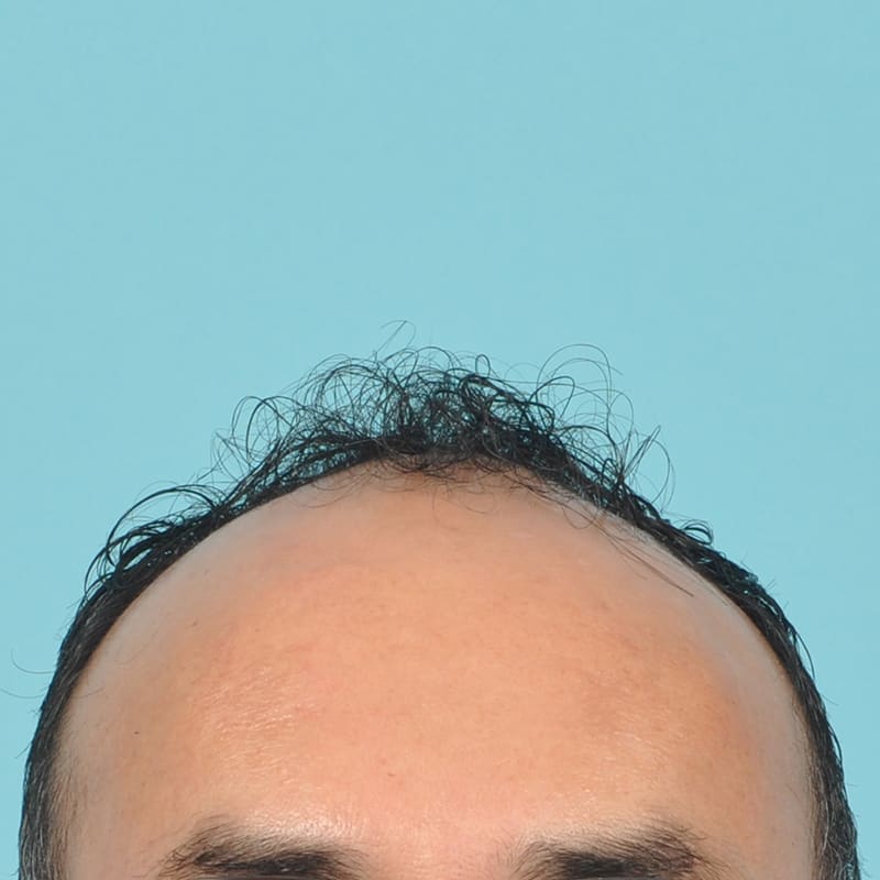 NeoGraft - Hair Restoration Before & After Image