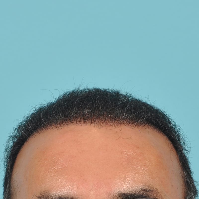 NeoGraft - Hair Restoration Before & After Image
