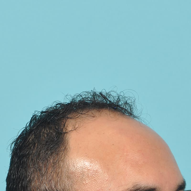 NeoGraft - Hair Restoration Before & After Image